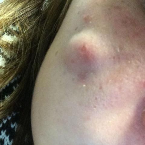 Schamlippe Pickel Zyste Scheide Intim Schamlippen Schamlippe Pickel Zyste Scheide Intim Schamlippen