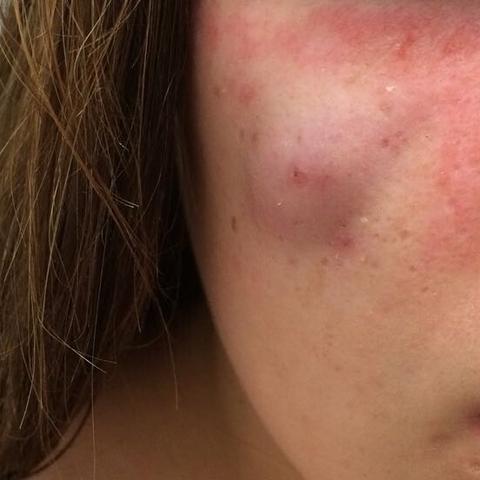 Schamlippe Pickel Zyste Scheide Intim Schamlippen Schamlippe Pickel Zyste Scheide Intim Schamlippen