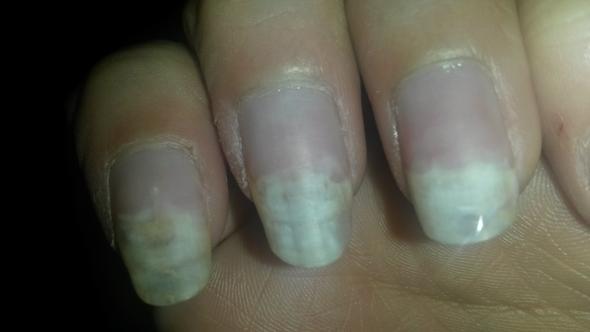 Nagelpilz Am Fingernagel Pilze Nagelpilz Am Fingernagel Pilze