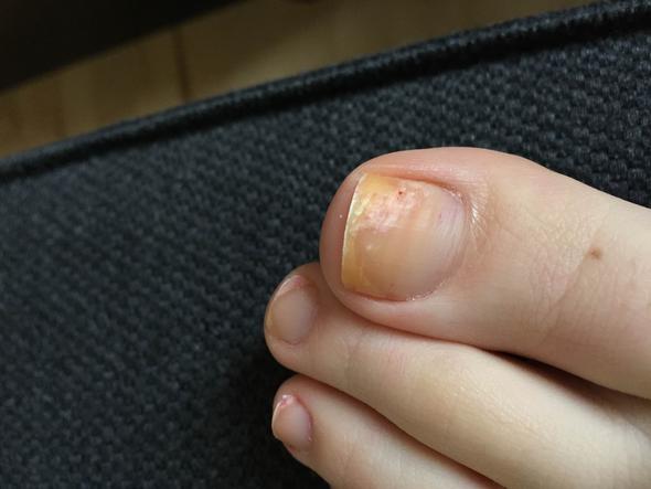 Ist das Nagelpilz? (Bilder)