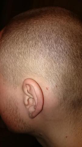 Von Was Bekommt Man Rote Kopfhaut Und Haarausfall Gesundheit Medizin Haare Von Was Bekommt Man Rote Kopfhaut Und Haarausfall Gesundheit Medizin Haare