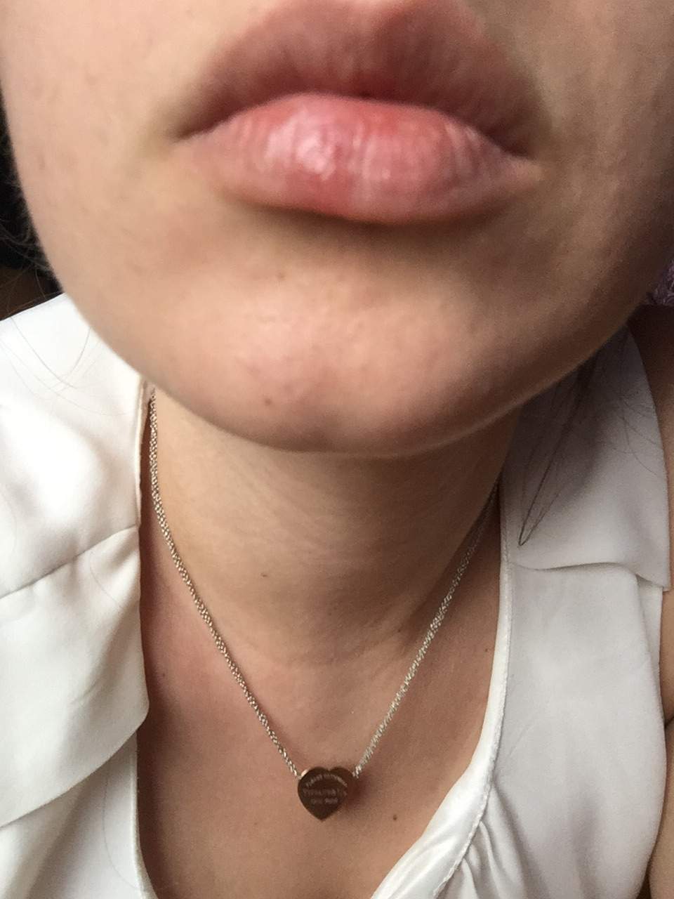 Ist das Herpes oder nicht? Lippe schwillt an aber es kommen keine bläschen