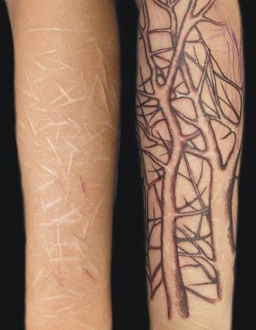 Narben Vom Ssv Ubertattowieren Tattoo