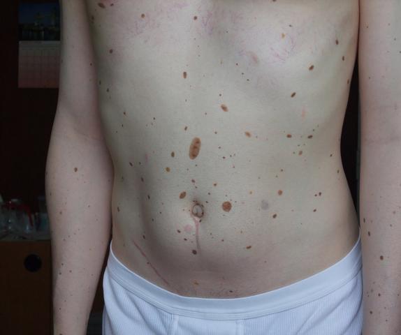 Schwerer dysplastischer Nävus - was genau heißt das? (Medizin, Angst, Haut)