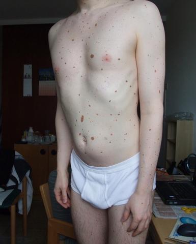 Dysplastisches Nävi Syndrom: mein Oberkörper - (Allgemeinwissen, Muttermal)