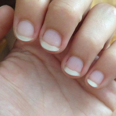 Meine Nägel haben so viel weißes, weil das Nagelbett zurückgegangen ist.  - (Nägel, kauen)