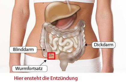 Wo genau liegt der Blinddarm und ist das eine Entzündung? (Arzt, Bauch)