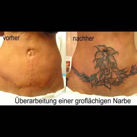 Kann Man Uber Diese Narben Tatowieren Tattoo