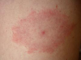 - (Angst, Zecke, Borreliose)