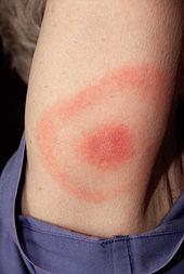 - (Angst, Zecke, Borreliose)
