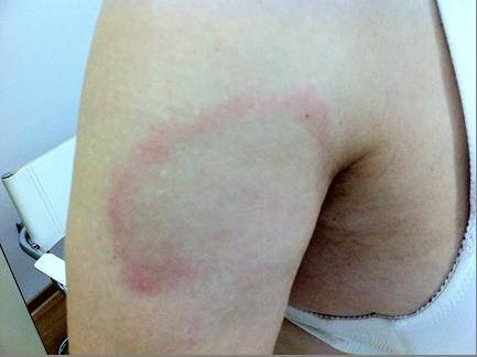 - (Angst, Zecke, Borreliose)