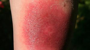 - (Angst, Zecke, Borreliose)