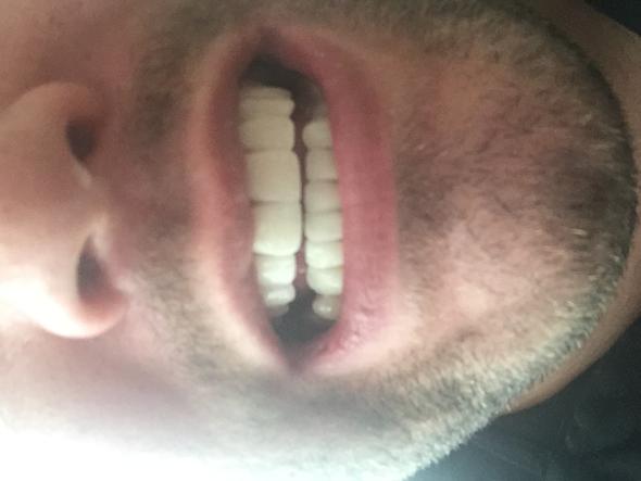 Hat Irgendjemand Erfahrung Gemacht Mit Veneers Zahne