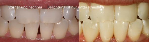 Vorher Nachher Komposit Zahnumformung Berlin - (Zahnfleisch, Zahnlücke, ästhetisch)