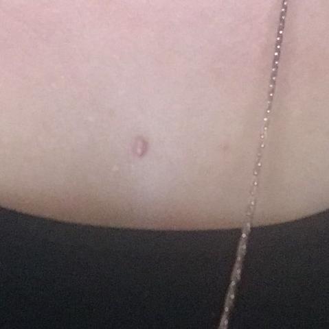 dermal anchor kosten und oberflachlich piercing