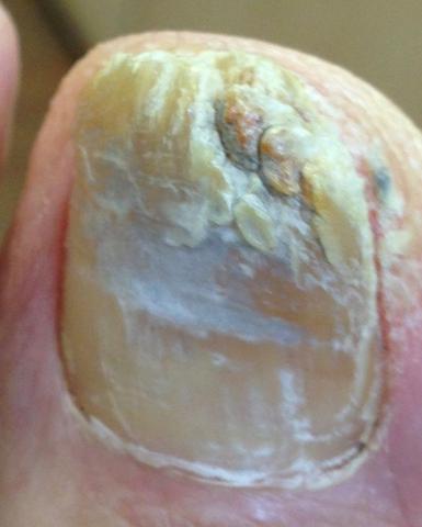 Mein Fußnagel nach der Behandlung mit dem Nagelpilz Öl und Nagelpilz Gel. - (Gelnägel, Nagelpilz)