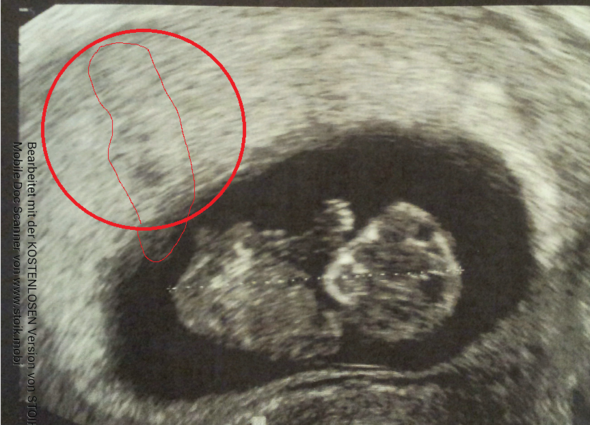Bild 3 - (Schwangerschaft, Baby, Gynäkologie)