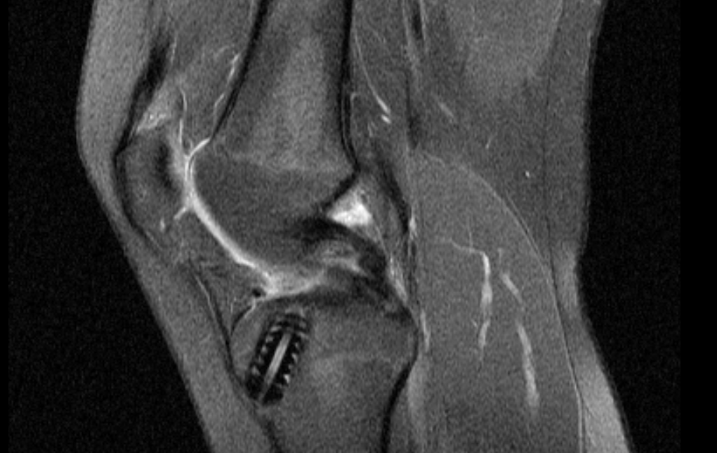 Kann mir jemand bei der Auswertung von MRT Bildern am Knie geben? (Arzt