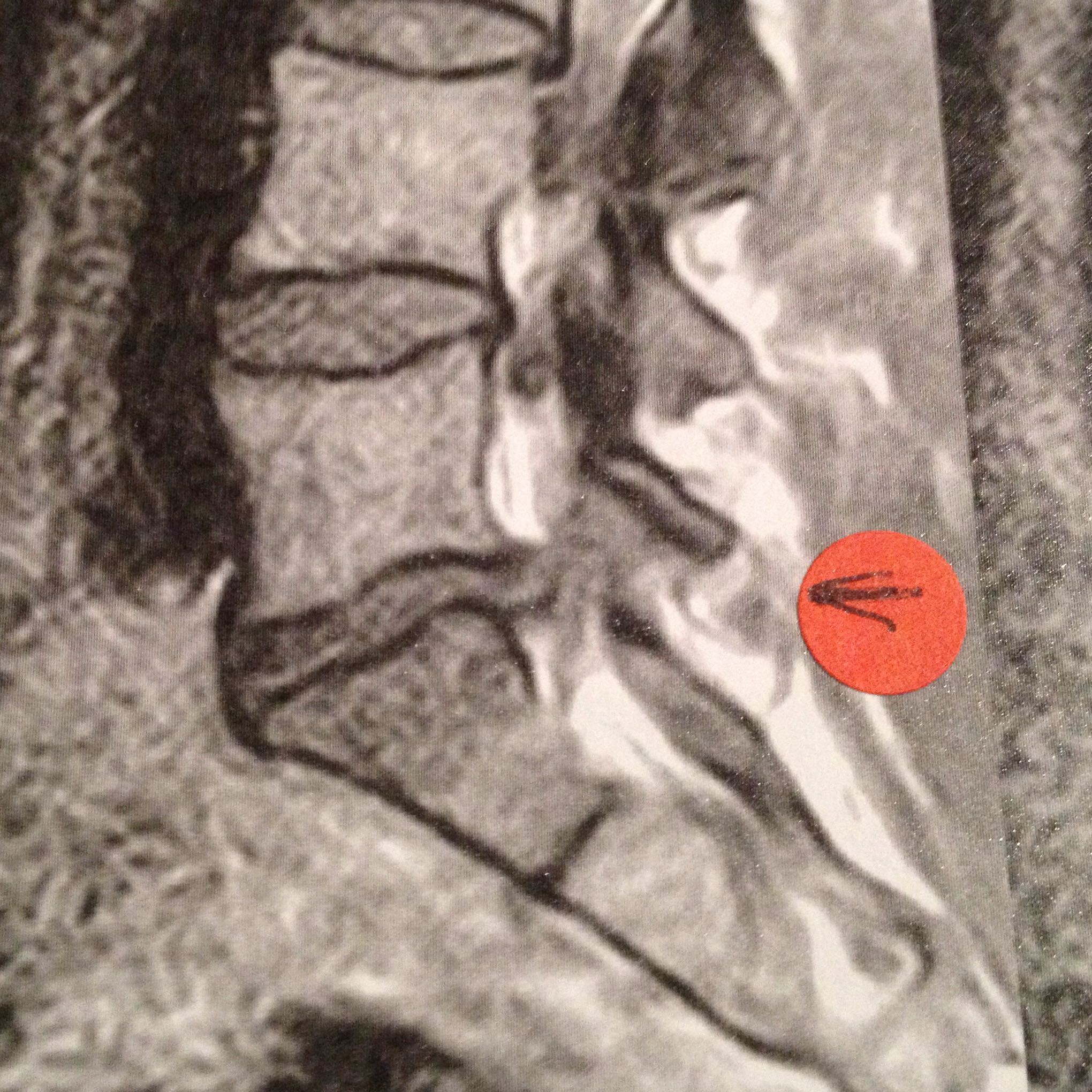 Kennt sich jemand mit MRT Bildern aus? (Bandscheibenvorfall) Kennt sich jemand mit MRT Bildern aus? (Bandscheibenvorfall)