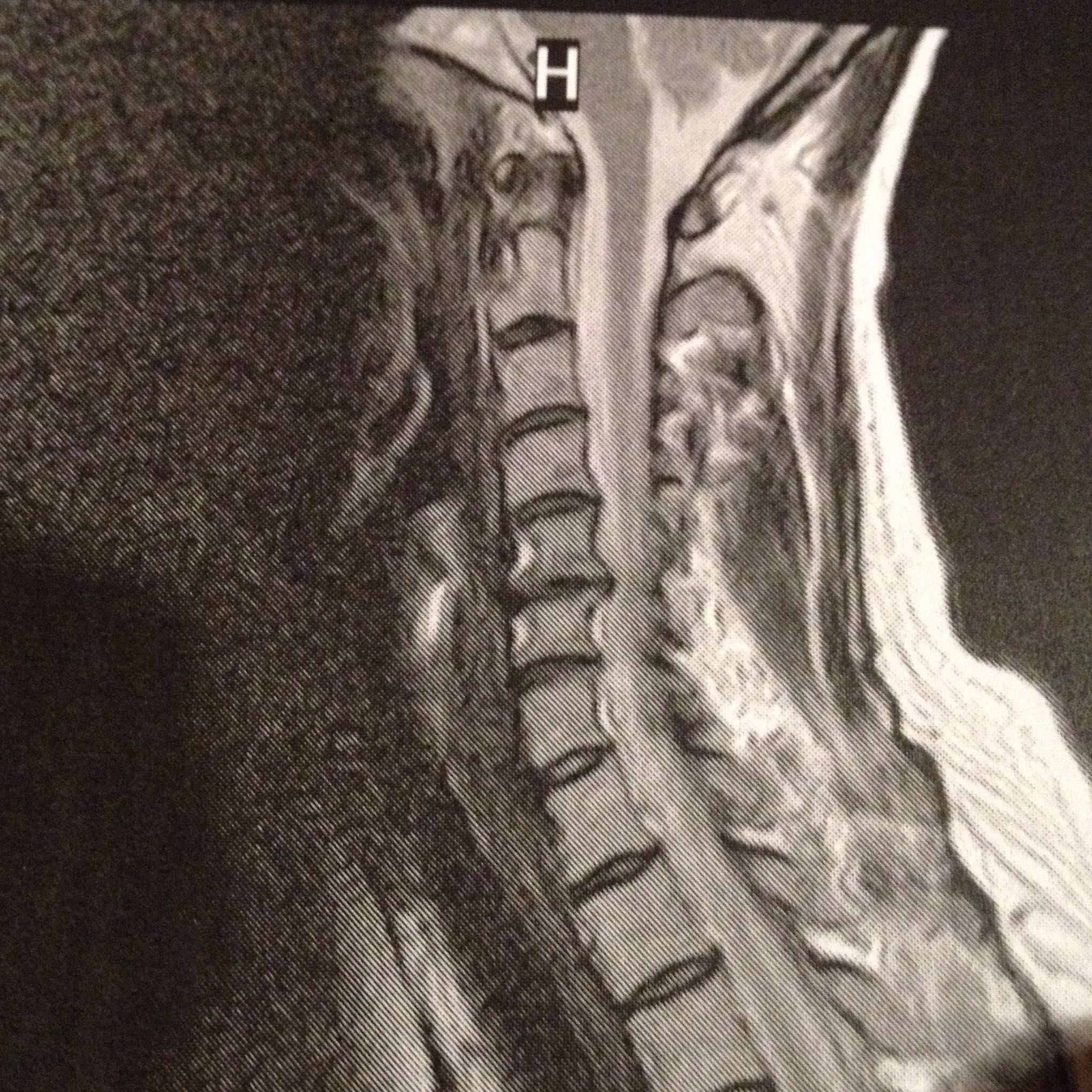 Kennt sich jemand mit MRT Bildern aus? (Bandscheibenvorfall) Kennt sich jemand mit MRT Bildern aus? (Bandscheibenvorfall)