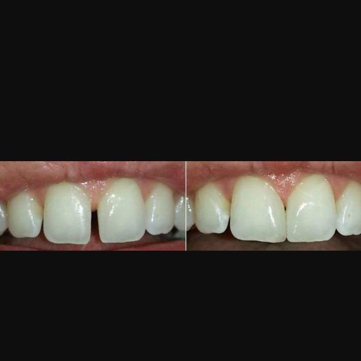 Zahnlücke schließen lassen wie? (Zähne, Lücke)