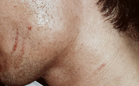 Narbe Durch Kratzer Im Gesicht Narben