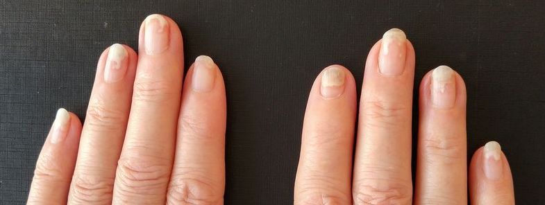 Trockene Nagelhaut Pflegetipps Fr Rissige Nagelbetten