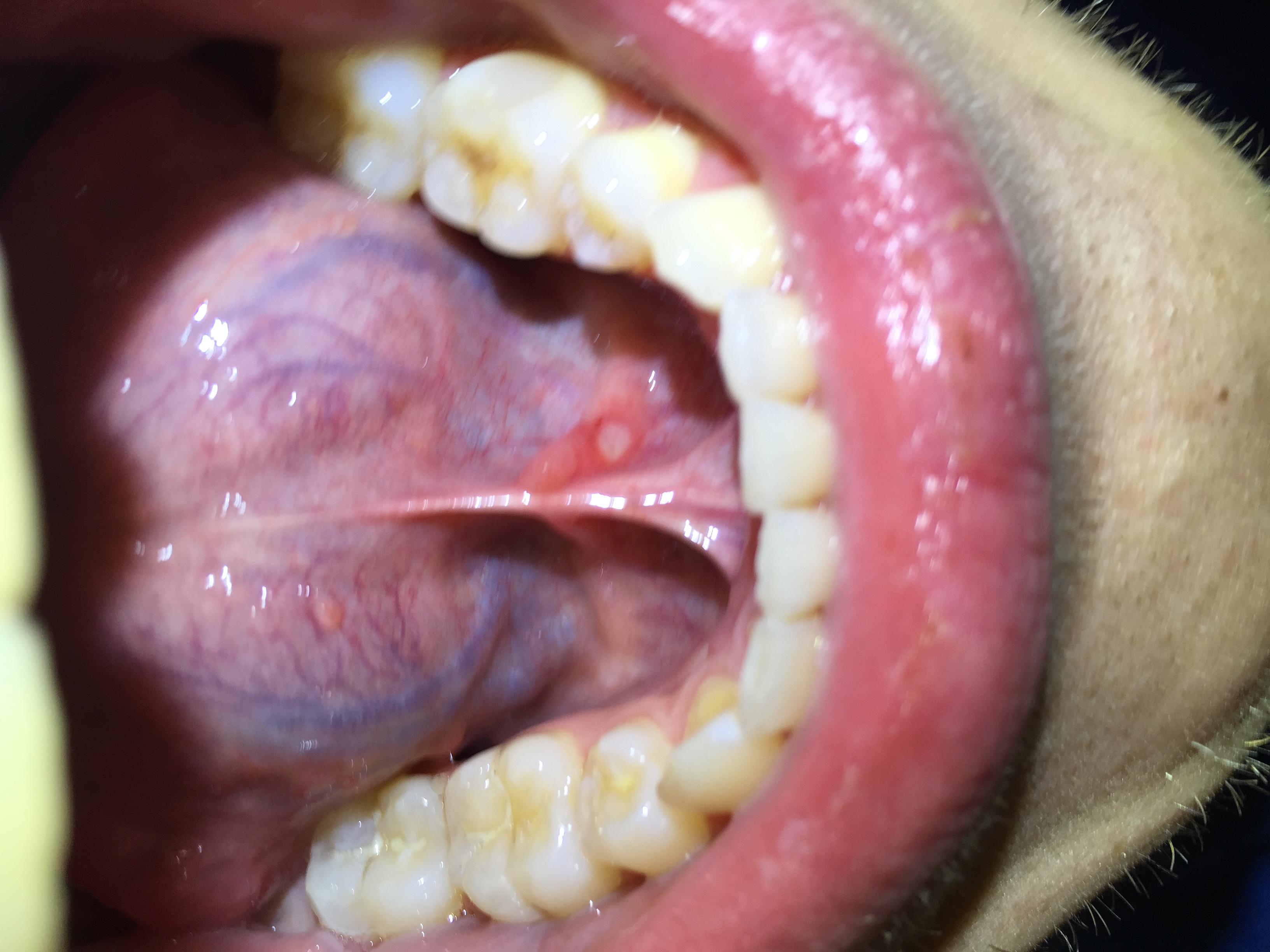 Pickel Auf Der Zunge - Weißer Punkt auf der Zunge seitlich - Denta