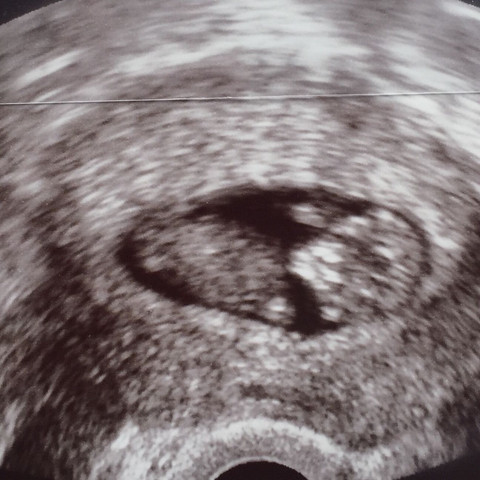 Da war ich Ca in der 10-11 ssw  - (schwanger, ultraschallbild)