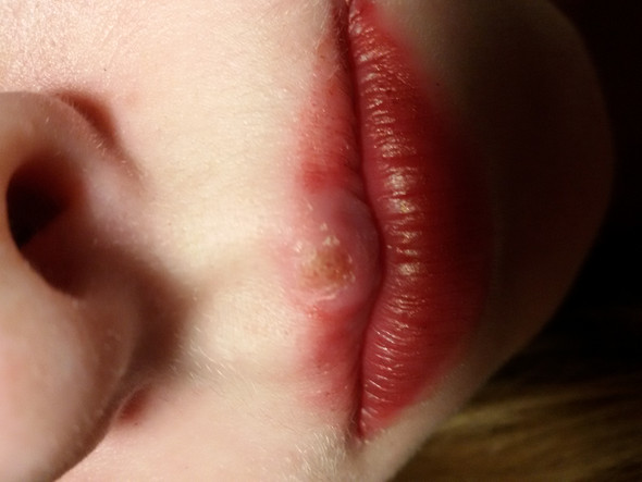 So sieht es aus - (Herpes, was dagegen tun)