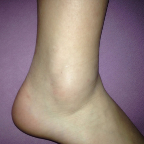 Darf Ich Meinen Fuss Langsam Wieder Belasten Nach Einem Banderriss Dehnung Banderdehnung Darf Ich Meinen Fuss Langsam Wieder Belasten Nach Einem Banderriss Dehnung Banderdehnung