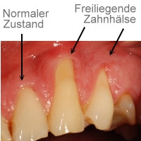 - (Zähne, Fleisch)