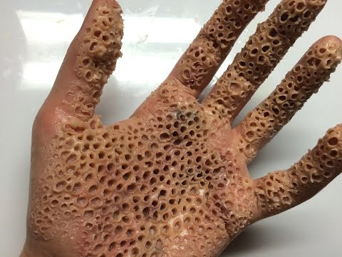 Es Gibt Eine Phobie Vor Kleinen Lochern Im Internet Findet Man Dazu Furchtbare Fotos Besonders Welche Von Lochern In Der Haut Gibt Es Das Wirklich Hautkrankheit Es Gibt Eine Phobie Vor Kleinen Lochern Im Internet Findet Man Dazu Furchtbare Fotos Besonders Welche Von Lochern In Der Haut Gibt Es Das Wirklich Hautkrankheit