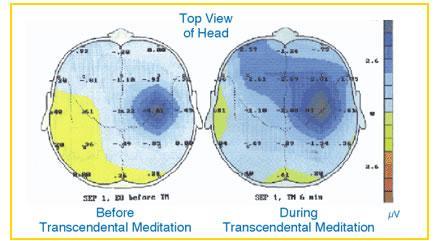 EEG-Karte während der TM - (Entspannung, Stirnfalten, stirnrunzeln)