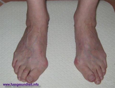 Solche Füße möchten sich viele Damen anlaufen - (Schuhe, Füße, Knochen)
