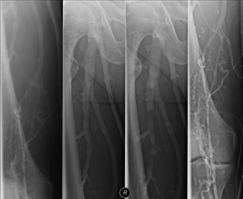 3 Etagen Thrombose - (Herz, Thrombose, Thrombus)