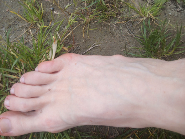 Abstehender Knochen am Fuß? (Gesundheit, Orthopädie)