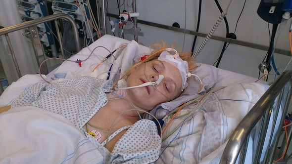 Aneurisma Im Kopf Geplatzt Hirnblutungen Bitte Um Antworten Hirnblutung Aneurysma Aneurisma Im Kopf Geplatzt Hirnblutungen Bitte Um Antworten Hirnblutung Aneurysma