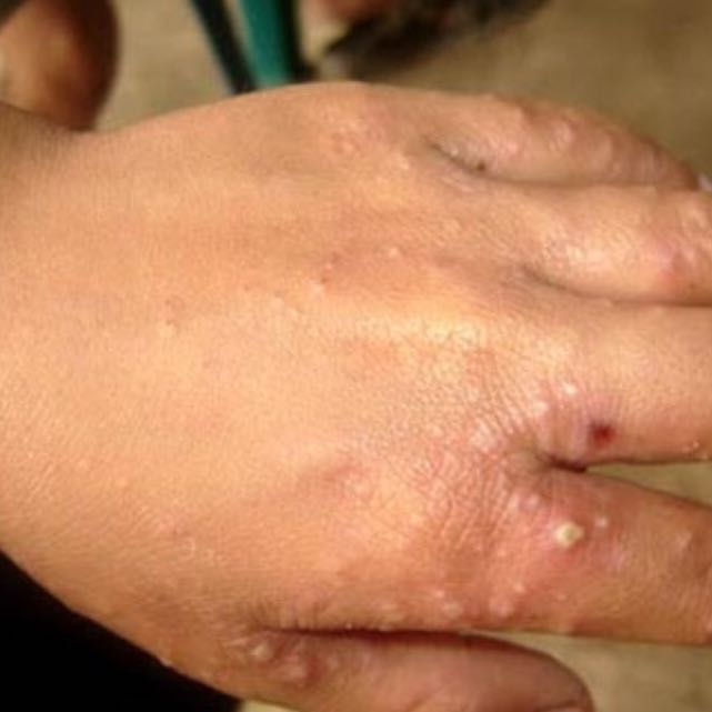 Scabies (schurft) - Huidziekten.nl (Dermatologie)