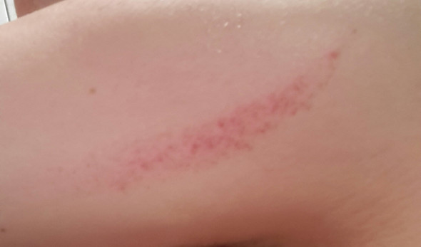 - (Haut, Ausschlag)