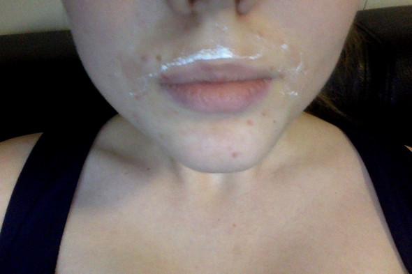 Hilfe Ich Hab Mir Mit Kaltwachs Die Oberste Hautschicht Rausgerissen Gesundheit Haut Verletzung