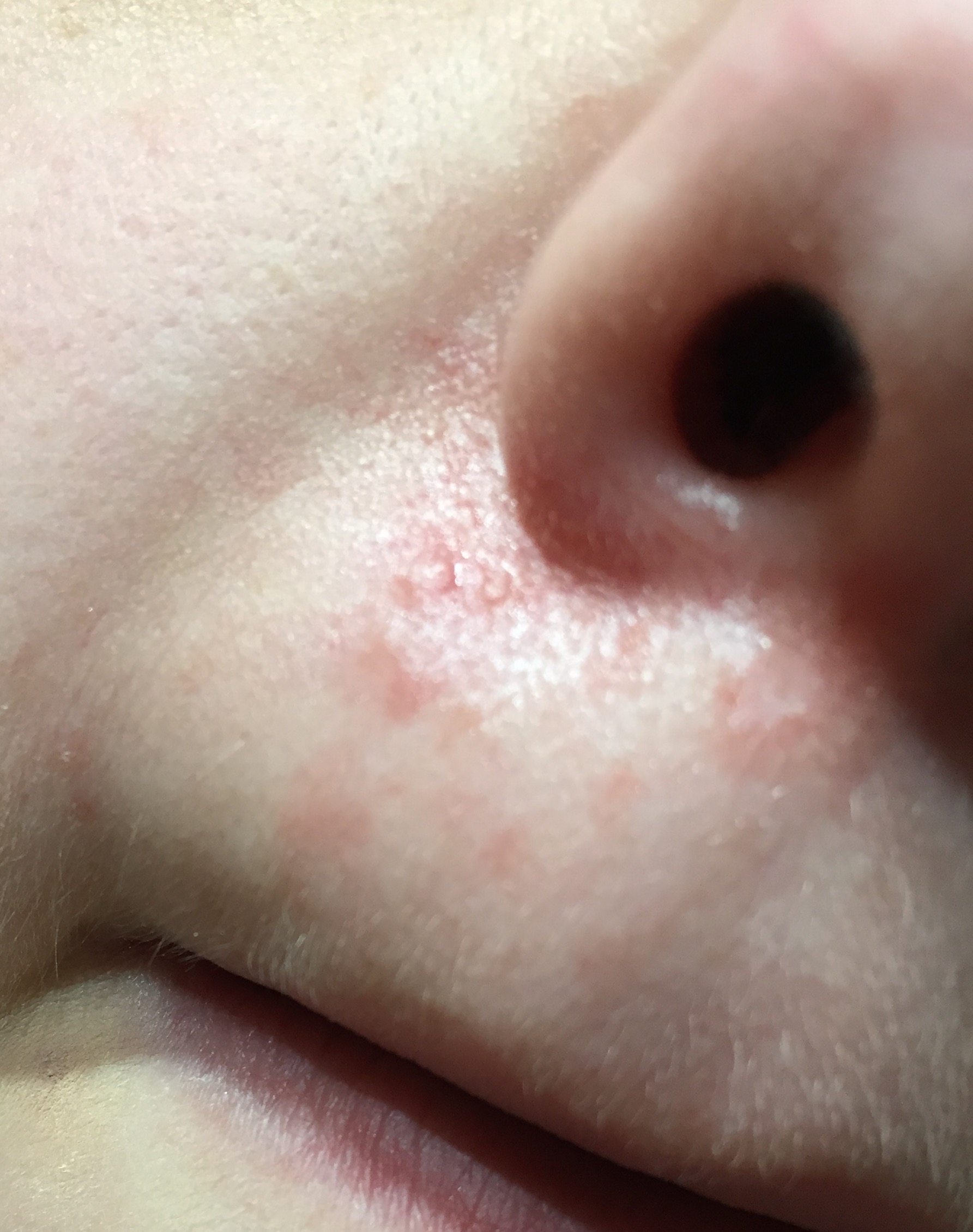 Seit Monaten Ausschlag an der Nase? (Herpes, fettige Haut, Pusteln)