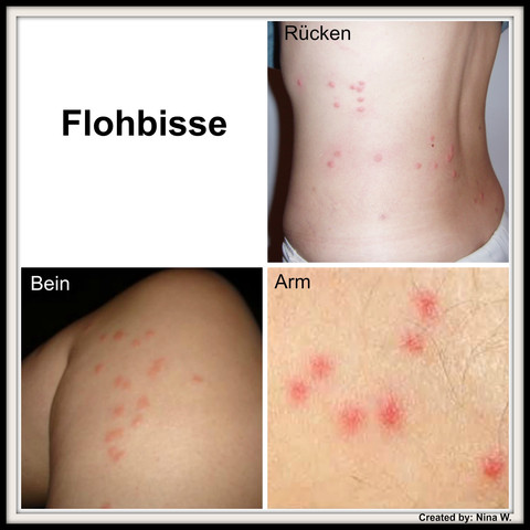 Flohbisse Am Menschen Medizin Katze Insekten