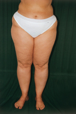 Lipodem Mit 14 Gesundheit Lipodem Mit 14 Gesundheit
