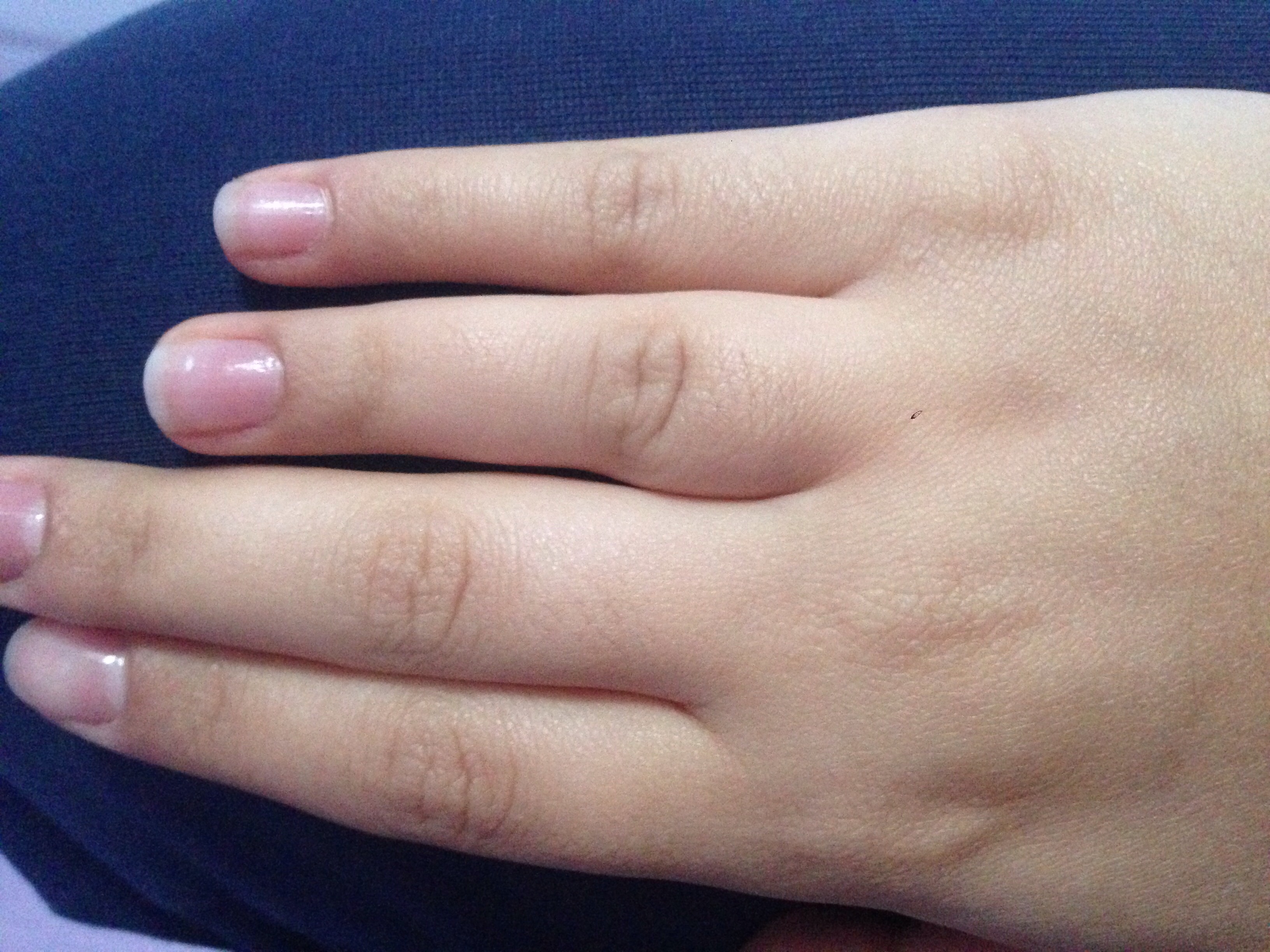 Was habe ich?! ( (Hand,Knochen,Ringfinger) (Finger, Ring, röntgen)