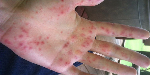 Nennt sich Hand-Fuß-Mund Krankheit - (Hand, kleine-rote-punkte)