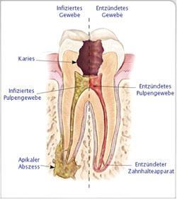 Schmerzen Nach Wurzelbehandlung Was Tun Zahnarzt Zahnmedizin Zahnschmerzen Schmerzen Nach Wurzelbehandlung Was Tun Zahnarzt Zahnmedizin Zahnschmerzen