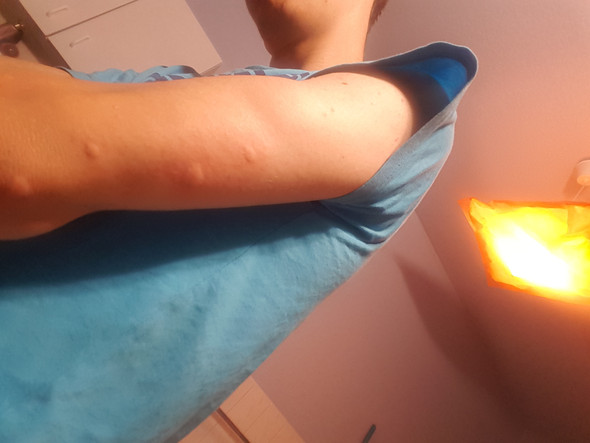 - (Wunde, Arm)