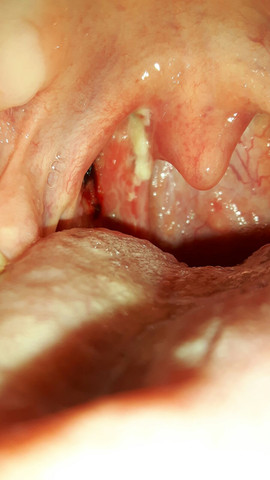 - (Gesundheit, Blut, Operation)
