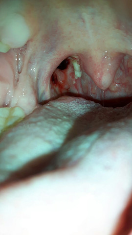 - (Gesundheit, Blut, Operation)